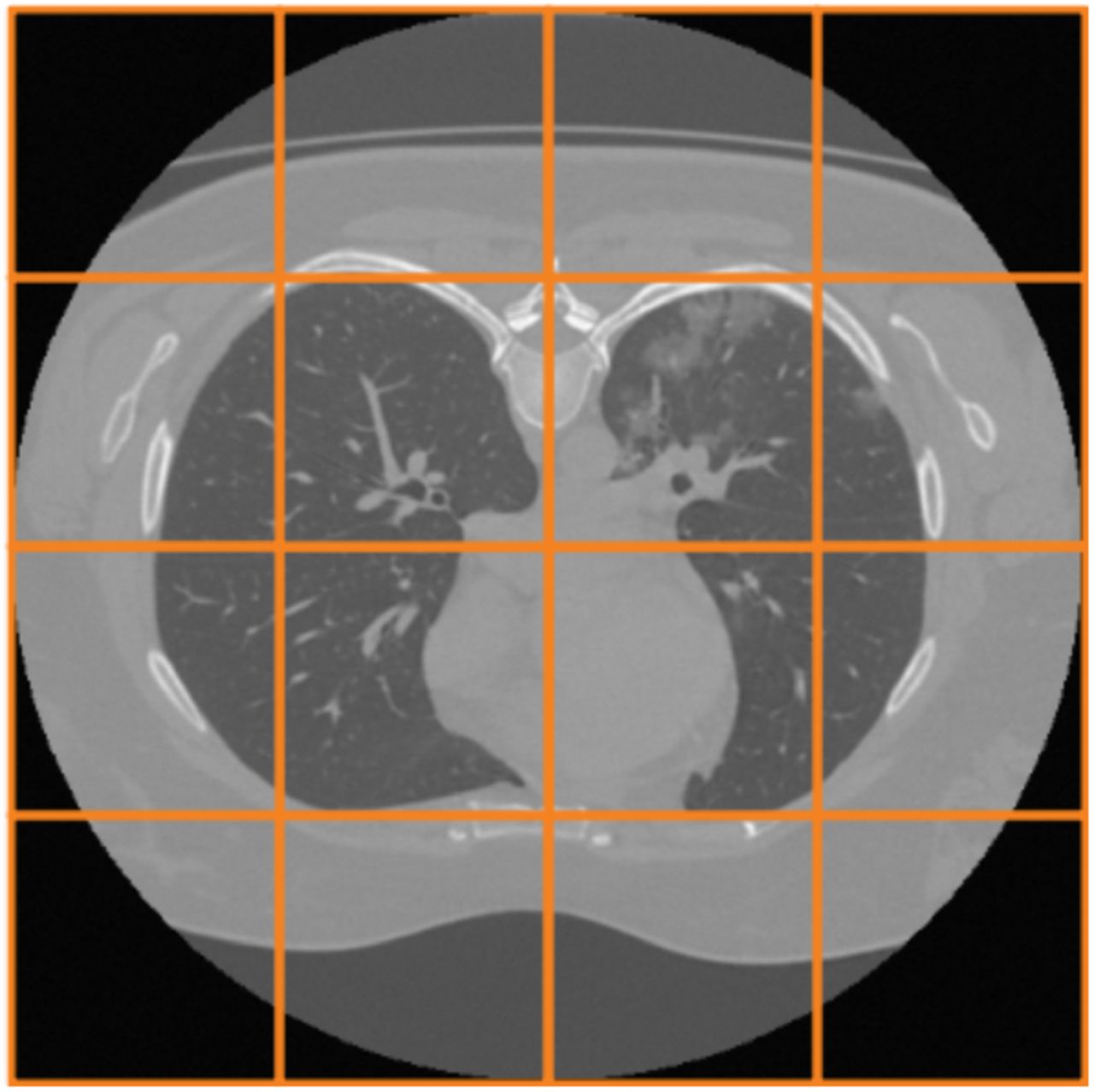Patch extraction from test CT slices.