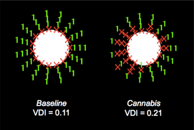 Graph made with the Halo v1.0 software for one participant in the baseline session and after smoking cannabis. VDI value is included. (Pupil size was 5 mm for both sessions).