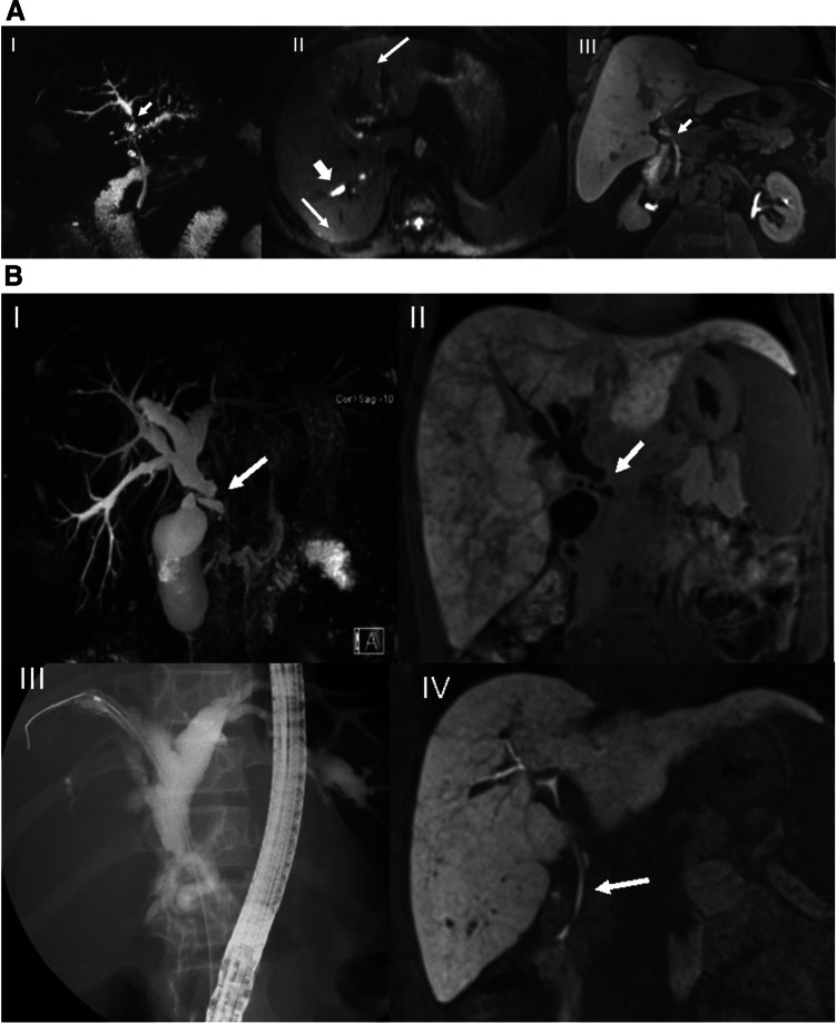 A A 56-year-old male with known PSC for four years. Conventional T2-MRCP (I) is suspicious for a high-grade stricture (HGS) in the hilum (arrow). Furthermore, moderate to significant dilatations and irregularities of the IHD are seen. Axial DWI (II) shows dilatation of the intrahepatic bile ducts in the right liver lobe (short thick arrow), as well as associated high SI in both lobes consistent with segmental cholangitis (thin arrows). Twenty-minute coronal HBP image (III) shows timely contrast media excretion via CBD into the duodenum (arrow), excluding a functional stricture. Thus, this was a false-positive MRCP diagnosis of DS and HGS. The patient developed no adverse event(s). B A 20-year-old female with PSC and a 2-year history of Crohn’s disease. Coronal MRCP (I) shows a suspected significant hilar stricture (arrow) with distinct dilatation of the intrahepatic bile ducts. On the 20-min coronal hepatobiliary phase (II), no contrast media excretion was seen in the biliary system compatible with a functional stricture (FS). There was also heterogeneous liver parenchymal enhancement. ERCP (III) 1 week later confirmed the diagnosis of FS in the mid-CBD, which was treated with dilatation. Three-month follow-up MRCP (IV) showed timely biliary excretion 20 min after contrast administration, as well as more homogeneous liver parenchymal enhancement, indicative of improved function after removal of the FS. C A 62-year-old male with PSC for 23 years. Axial T2-TSE (I), coronal 3D-MRCP (II), and axial (III) and coronal (IV) T1 3D GRE in the HBP show signs of advanced PSC on MRCP with cystic dilatation (II, arrow), and multiple stenoses of the intrahepatic bile ducts, as well as a pruned tree appearance (I, II). The liver shows diminished uptake of hepatobiliary contrast agent relative to the left kidney (III, IV) without excretion at 20 min (IV, arrow), indicative of hepatocellular dysfunction (HD) with signs of cirrhosis, including dysmorphy and portal hypertension (including splenomegaly, III and IV). Four months later, the patient underwent OLT