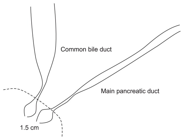 Schematic illustration of the main pancreatic duct opening and distal common bile duct signs.