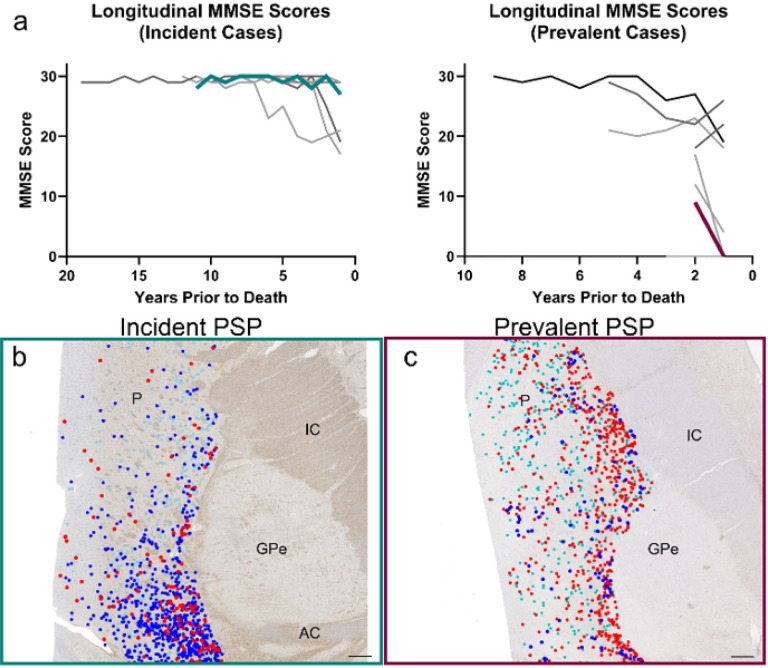 Clinical and neuropathological comparison of incident and prevalent PSP cases from the UK-ADRC.This figure shows the longitudinal cognitive trajectories and spatial distributions of PSP-related pTau pathology in incident and prevalent PSP cases. SeeSupplemental Table 7 for detailed information on each case. Longitudinal MMSE scores were plotted as years prior to death for incident PSP cases and prevalent PSP cases (a). Individuals’ results are shown as lines, with color-coded traces corresponding to the representative tissue maps in panels b and c. These show digitized tissue sections from representative incident PSP (b) and prevalent (c) PSP cases, overlaid with automated detections of pTau pathologic lesion subtypes. Colored markers denote detected NFTs (red), TAs (blue), and CBs (teal). Abbreviations: P = putamen, IC= internal capsule, GPe = external segment of globus pallidus, AC = anterior commissure. Scale bars represent 1mm.