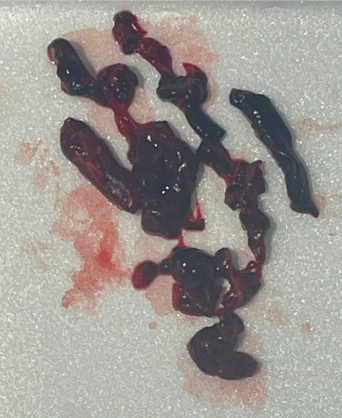 Intraoperative image of pulmonary embolus.