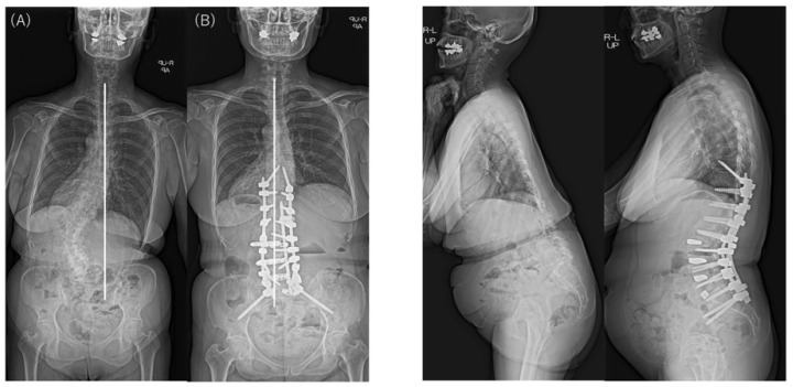 Preoperative and postoperative standing radiographs showing coronal and sagittal correction using anteroposterior staged surgery for ASD in a 63-year-old woman with type 1 CM. CBD changed from 41.6 mm preoperatively (A) to –3.2 mm postoperatively (B), with the C7 plumb line on the opposite side of the CBD. Sagittal alignment improved significantly, and postoperative CM also improved to CBD < 20 mm. CM, coronal malalignment; CBD, coronal balance distance.