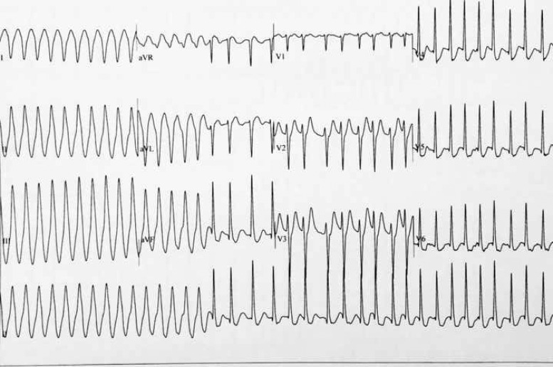 Patient 1: Exercise test, recovery phase. Conversion of ventricular tachycardia to supraventricular tachycardia during Valsalva manoeuver.