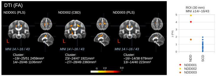 Voxel-wise statistical comparisons in three patients with neurodegenerative diseases (NDDs; primary lateral sclerosis [PLS] for NDD001, corticobasal degeneration [CBD] for NDD002, and PLS for NDD003) regarding fractional anisotropy (FA) from diffusion tensor imaging (DTI) by whole brain-based spatial statistics (WBSS) against 19 individuals with subjective cognitive deficits (SCDs), considering false-discovery rate (FDR) adjustments. Maximum cluster coordinates (in Montreal Neurological Institute [MNI] space) and sizes are provided. Hot color clusters indicate decreases, while a cold color cluster (in NDD002) indicates increases in FA. Additionally, region of interest (ROI) analysis results for a ROI in the upper corticospinal tract (CST) are shown in comparison to the subjects with SCDs. “L” indicates the left hemisphere.