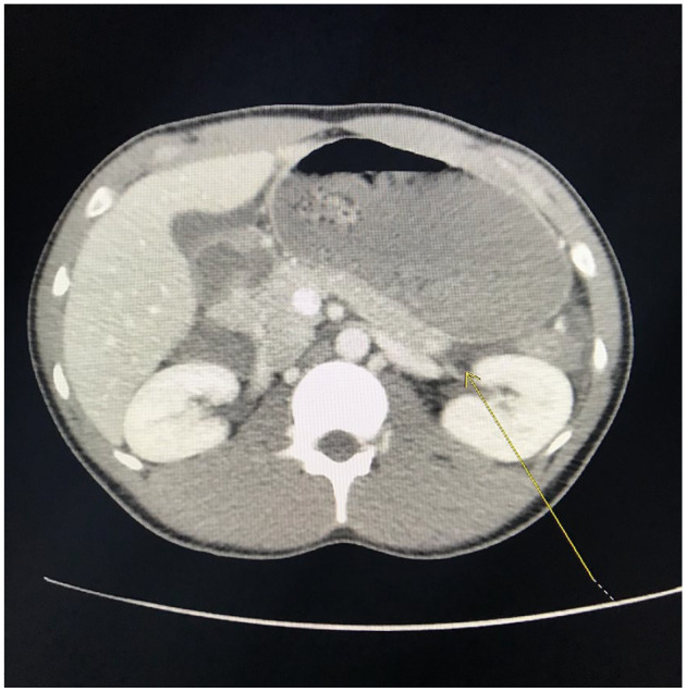 T1-weighted computed tomography images demonstrate distal necrotizing pancreatitis with adjacent moderate free fluid (marked with yellow arrow) compatible with an acute necrotic collection.
