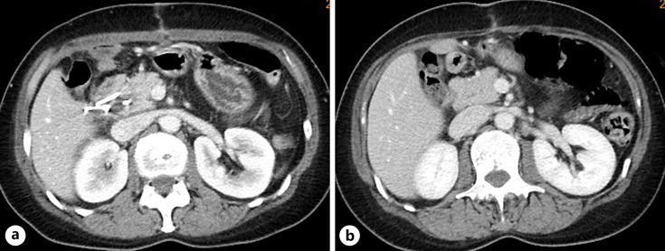 CT after endoscopic ultrasound-guided transduodenal drainage. a CT on the 29th POD. The fluid retention on the upper edge of the head of the pancreas had shrunk to a thickness of approximately 20 mm. The fluid on the surface of the liver was also reduced. b CT approximately 2 months after discharge. The fluid retention on the upper edge of the pancreas has disappeared.
