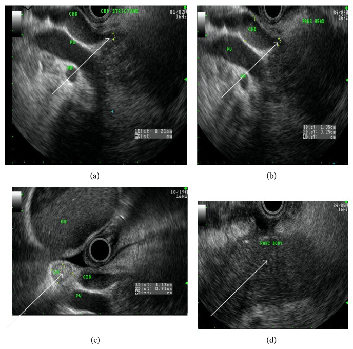 Endoscopic ultrasound images arrows showing (clockwise) (a) CBD stricture, (b) dilated CHD, (c) reactive lymph node, and (d) homogenous pancreatic body.