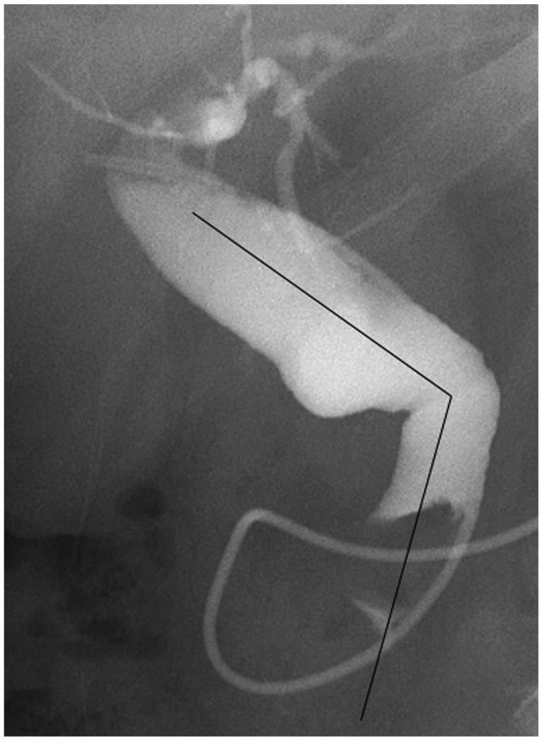 Measurement of the common bile duct angle. The first angulation from the ampullary orifice is measured on a cholangiogram obtained in the prone position.
