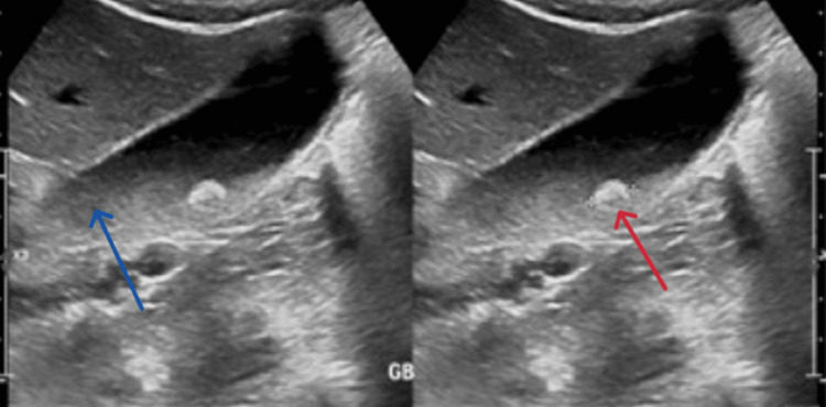 Transabdominal ultrasound findings of the gallbladderTransabdominal ultrasound demonstrates a distended gallbladder with an 8 mm gallstone (red arrow) and associated thick sludge formation (blue arrow). Mild gallbladder wall thickening is also noted, consistent with acute calculous cholecystitis.