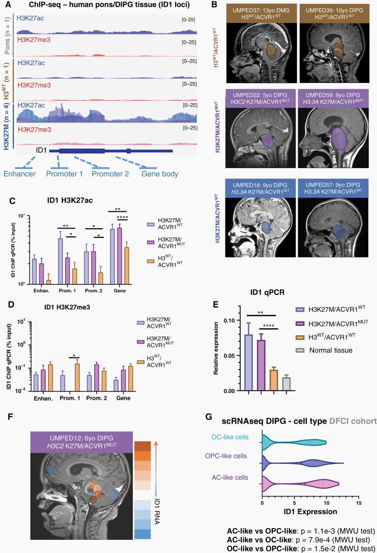 ID1 is epigenetically active in H3K27M-DIPG. (A) ChIP-sequencing of H3K27ac and H3K27me3 deposition at ID1 gene locus in H3K27M human DIPG tumor tissue (n = 4), H3WT DIPG tumor tissue (n = 1), and normal human pontine tissue (n = 1). (B) Multifocal DIPG tumor samples were obtained at autopsy from n = 2 patients with H3K27M mutation and wildtype ACVR1 (ACVR1WT), n = 2 patients with H3K27M mutation and ACVR1 mutation (ACVR1MUT), and n = 3 patients with wildtype H3 and ACVR1. Circles over MRI images represent approximate region of tumor. (C–D) ChIP-qPCR quantification of deposited (C) H3K27ac, and (D) H3K27me3 marks at gene body elements identified in part A for ID1. Data represent samples from patients in (B), mean ± SEM; *P < .05, **P < .01, ****P < .0001, one-way ANOVA t-test. (E) ID1 expression (qPCR) for multifocal samples collected from patients in (B) showed highest ID1 expression in H3K27M tumors. Data represent mean ± SEM; **P < .01, ****P < .0001, one-way ANOVA t-test. (F) MRI of H3K27M/ACVR1MUT DIPG patient with circles representing regions where samples were obtained at autopsy. Color scale on right displays relative level of ID1 expression by qPCR (orange = higher ID1 expression; blue = lower ID1 expression). (G) ScRNA-seq data (DFCI, n = 4 DIPGs) of malignant DIPG cells plotted to show ID1 expression across varying subtypes of cells [oligodendrocyte-like (OC-like); OPC-like; AC-like]. AC-like vs OPC-like: p = 1.1e-3; AC-like vs OC-like: p = 7.9e-4; OC-like vs OPC-like: p = 1.5e-2, Mann–Whitney U (MWU) test.