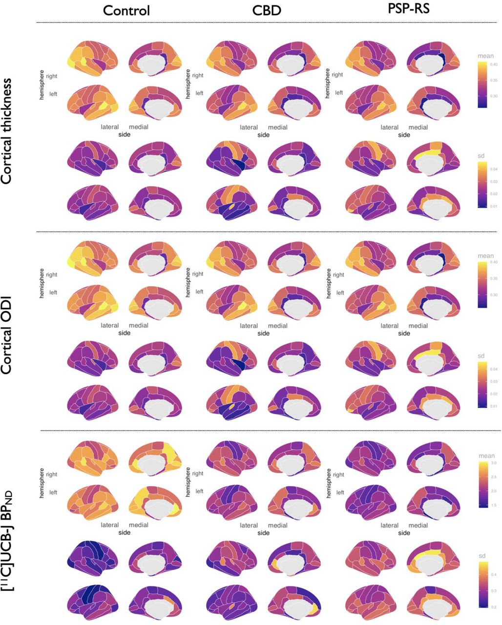 Regional distributions of cortical thickness, cortical ODI and cortical [11C]-UCB-J BPND across controls, CBD, and PSP-RS.Abbreviations: ODI = Orientation Dispersion Index, CBD = amyloid negative Corticobasal Syndrome; PSP-RS = Progressive Supranuclear Palsy-Richardson’s Syndrome; sd = Standard deviation.