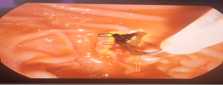 ERCP Stone ExtractionEndoscopic view of the major duodenal papilla during endoscopic retrograde cholangiopancreatography (ERCP). Following sphincterotomy (red arrow), a pigmented biliary stone (black arrow) is extracted from the common bile duct into the duodenal lumen, using a balloon catheter (white arrow).