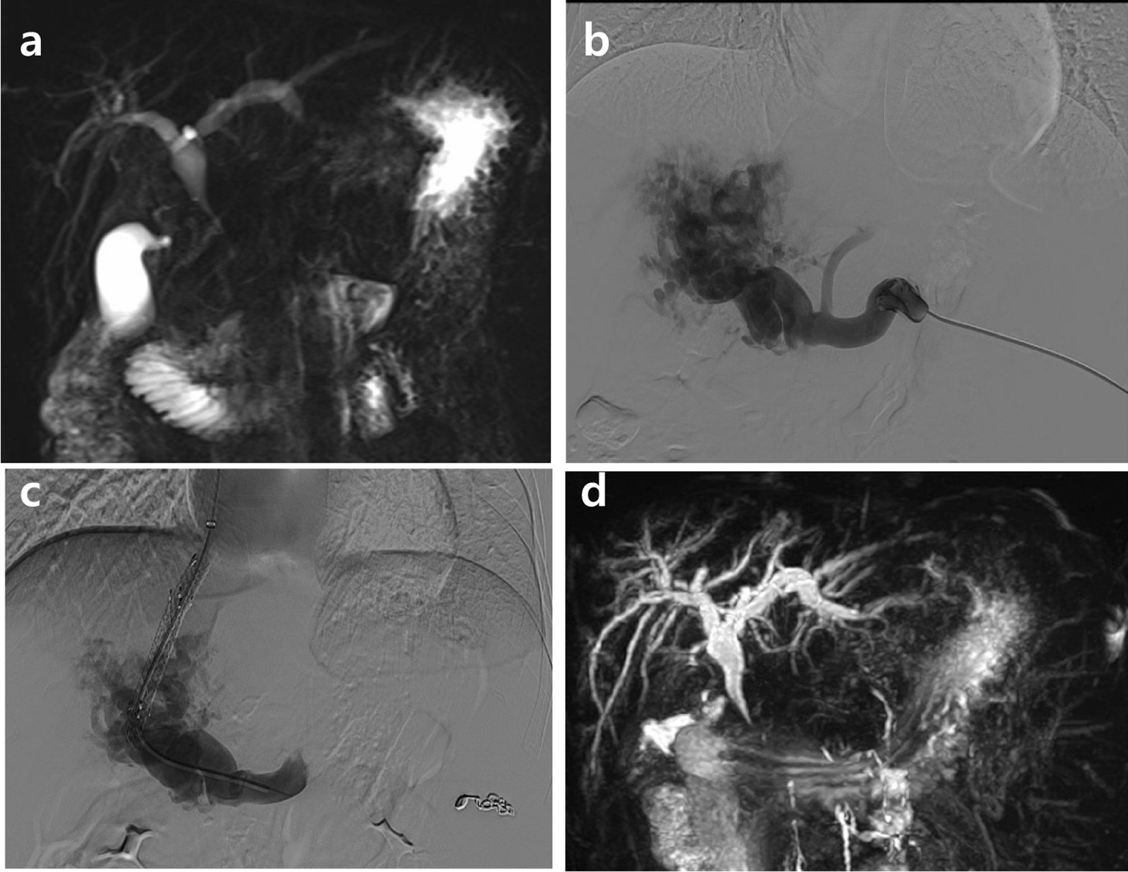 MRCP images before and after TIPS. a MRCP images showed multiple tortuous hepatopetal collateral vessels compressing the common bile duct, and leading to the dilated proximal bile duct before operation. b Portography performed before TIPS via a transsplenic access demonstrated cavernomatous transformation of the portal vein. c Portography performed after TIPS showed good outflow in the stent. d The biliary obstruction was alleviated after TIPS