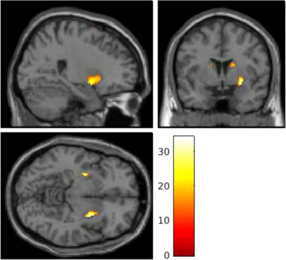 Statistical parametric maps showing that a main effect of group in the striatum during working memory in first episode psychosis patients relative to healthy volunteers ((MNI coordinates: x = 30, y = 2, z = −8); F = 34.32, Z = 5.43, cluster size = 201, p < 0.001).These findings survived family-wise error (FWE) correction on the basis of the peak-level extent (pFWE < 0.05). The colour bar shows the t statistic.