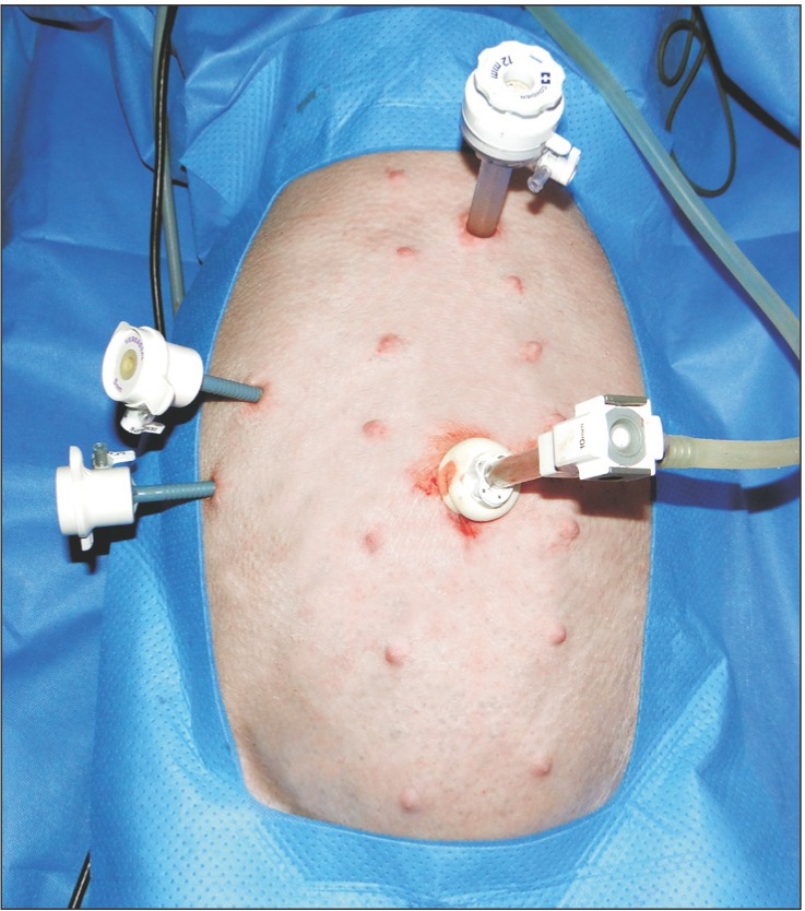 Trocar locations are the same as with standard laparoscopic cholecystectomy.