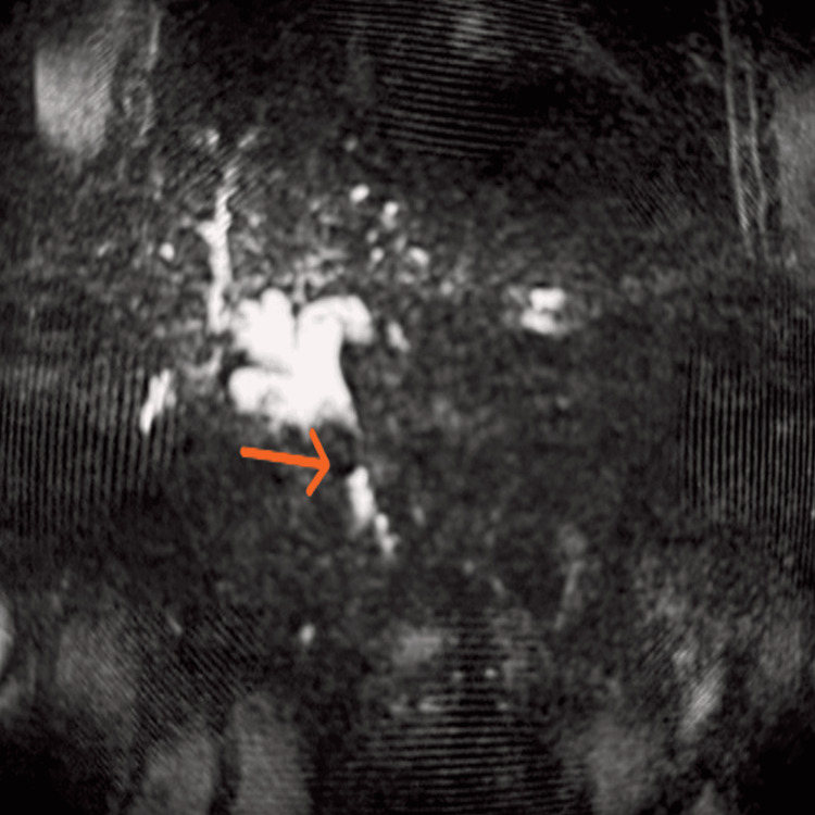 Magnetic resonance cholangiopancreatography (MRCP) shows a bright biliary tree with a central filling defect seen in the mid common bile duct region, suggestive of a calculus
