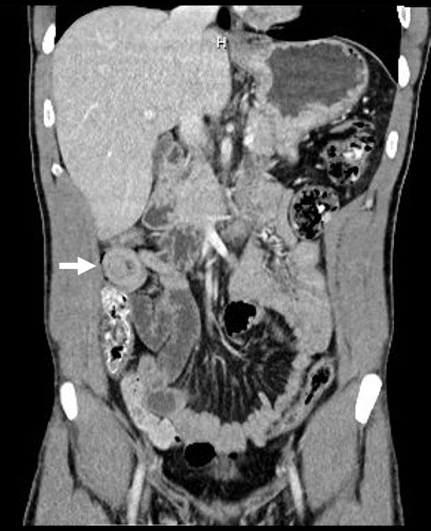 Computed tomography (CT) of abdomen (coronal with arrow) showing small bowel short segment intussusception areas without proximal dilatation.