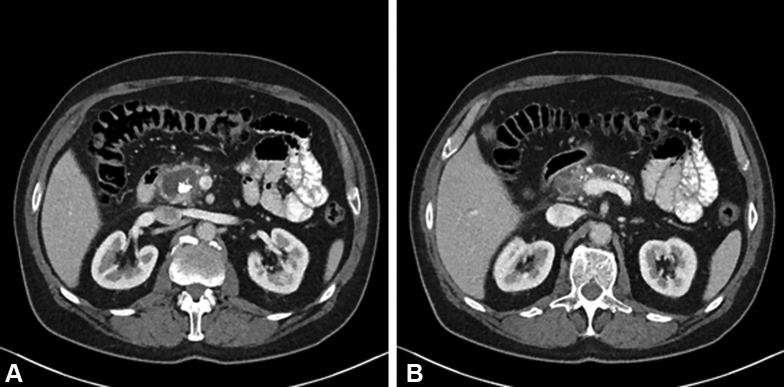 A andB: CT of the abdomen shows two obstructive pancreatic duct stones with upstream dilatation of the main pancreatic duct. Image A shows a pseudocyst in communication with the pancreatic duct.