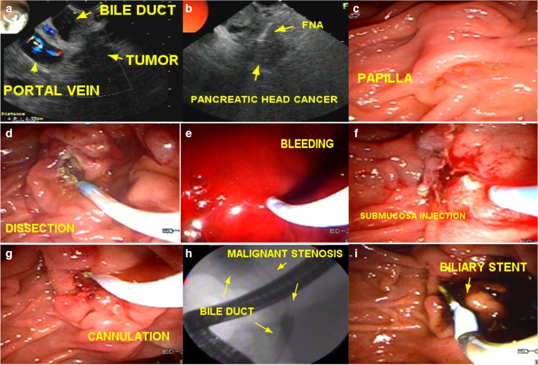 EFP2: enlarged fistulotomy of the papilla second attempt. a pancreatic head tumor; b FNA of pancreatic câncer; c difficult papilla and failed cannulation with the guide wire; d EFP1 with wide incisions and dissection of the papilla; e bleeding; f hemostasis was achieved by submucosa injection of saline and coagulation; g 2 days later the fistular orifice is identified and easy cannulation of the common bile duct is performed; h passage of the guidewire through the malignant stenosis; i biliary stenting