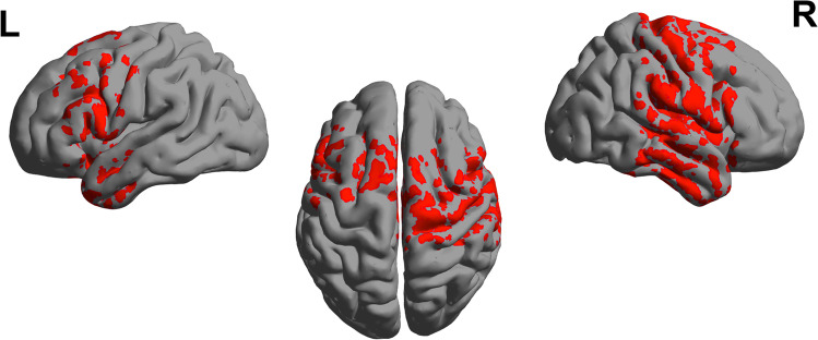 Relative spectral power of alpha band, during eyes closed. p values of statistical differences in BrainNet viewer source-space between CUD patients and controls. Red indicates greater power for patients (p < 0.05)