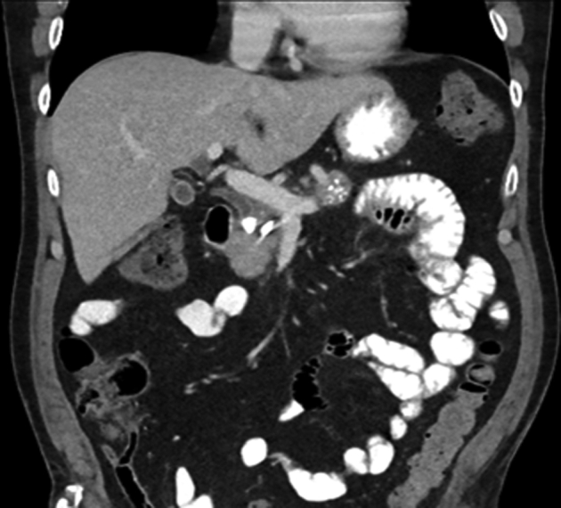 CT of the abdomen showing compression of the bile duct by the pancreatic stone.