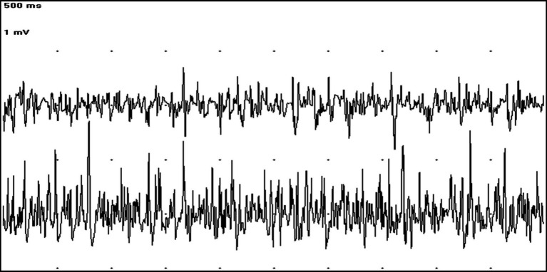 EMG tracings showing at the same time MUAPs in the cranial tibialis (trace above) and gastrocnemius muscles (trace below) (50 ms/Div; 1 mV/Div).
