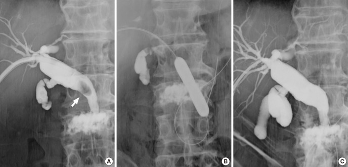 Cholangiograms of CBD stone removal by percutaneous transhepatic papillary large-balloon dilation. (A) A large stone is visualized in the dilated common bile duct (arrow). (B) The papilla was percutaneously dilated by inflating a large-bored balloon catheter. (C) Image obtained after dilation showing spontaneously discharged stone through the dilated papilla.