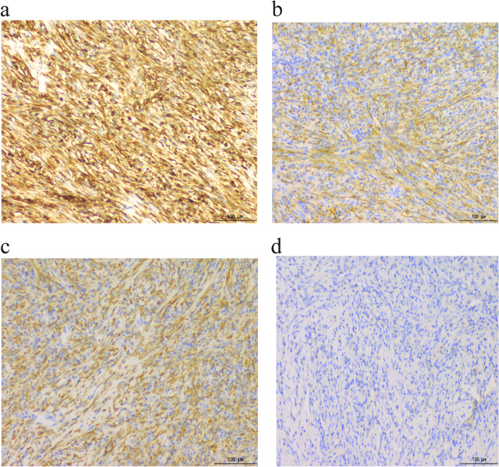 a Positive staining with vimentin (100×). b Positive staining with ALK (100×). c Positive staining with SMA (100×). d Negative staining with Dog-1 (100×)