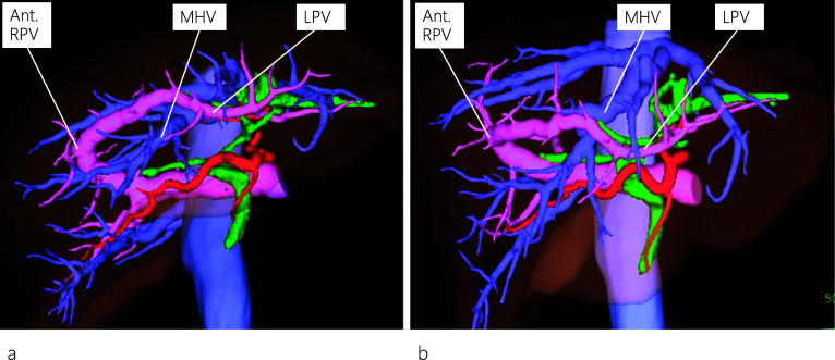 Three-dimensional reconstruction of the enhanced CT images. The left hepatic artery and bile duct are separated from the left portal vein (LPV) instead of being located in the left Glisson’s sheath as viewed from a left anterior oblique position (a). LPV, viewed from a neutral position, runs through the ventral side of the middle hepatic vein (MHV) (b). MHV: middle hepatic vein; Ant. RPV: anterior right portal vein; LPV: left portal vein