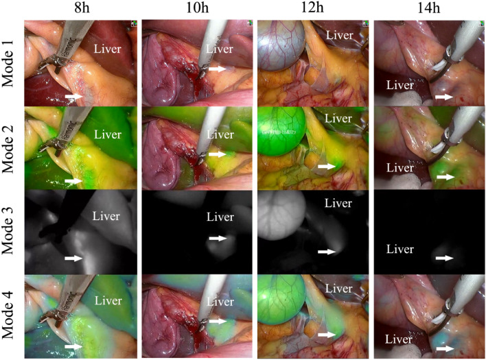 The fluorescence of the liver and extrahepatic biliary tract (arrow) of the four groups of patients after using the NIRF imaging system during the operation. 8 h, patients in group A were injected with 10 mg ICG 8 h prior to surgery. 10 h, patients in group B were injected with 10 mg ICG 10 h prior to surgery. 12 h, patients in group C were injected with 10 mg ICG 12 h prior to surgery. 14 h, patients in group D were injected with 10 mg ICG 14 h prior to surgery