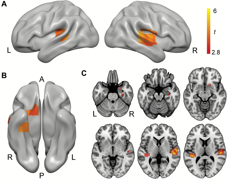 Cannabis without cannabidiol (CBD) dampened brain response to music across several regions sensitive to music-evoked reward and emotion. (A) Bilateral auditory cortex activation clusters visualized on the cortical surface of a standard template (MNI152). (B) A ventral view of the same template showing right-hemisphere amygdala and hippocampal clusters. (C) Axial slice views of the same contrast showing amygdala, hippocampal, ventral striatal (top row), and auditory cortex (bottom row) activation clusters. All activation maps thresholded at P<.05 (FDR corrected for multiple comparisons). A,anterior; L, left hemisphere; P,posterior; R, right hemisphere.