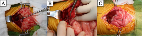 Process of exploratory laparotomy. (A) Protruded mucocele from ruptured GBM. (B) Ligation of the cystic duct with PDSII 3‐0 and two clips. (C) Left lateral liver lobe biopsy using the Guillotine method.