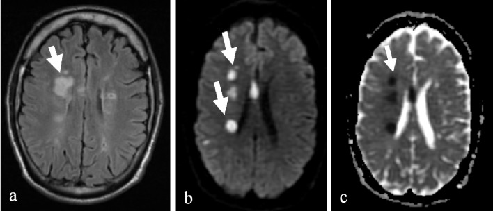 MRI head showed multiple foci of abnormal signal intensity in the right cerebral hemisphere and a small focus in the left parietal region representing acute ischemic changes as shown by arrow. (a) T2 flair. (b) Diffusion weighted image. (c) Apparent diffusion coefficient.