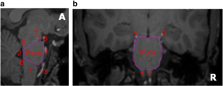 Manual delineation of the pons on MRI. (a) Sagittal view, (b) coronal view, A — Anterior, R — right. The pons was first delineated on sagittal views, followed by coronal and axial views, with the following limits; anterior/ventral: cisterna interpeduncularis and basilar artery (1); posterior/dorsal: floor of the fourth ventricle (2); superior: a line was drawn from the floor of the fourth ventricle below the superior cerebellar peduncle (3) along the lower limit of the cerebral peduncle, to the indentation between the pons and the midbrain (4); inferior: a line was drawn from the floor of the fourth ventricle above the inferior peduncle (6) to the upper limits of the olive and pyramid of the medulla oblongata (7), i.e. to the indentation between the pons and medulla oblongata (8); on coronal view: following anatomical boundaries of pons, which are clearly visible; on axial view: following delineation in both sagittal and coronal views, the pons is now clearly delineated, and the axial view is used for verification. [5 — posterior cerebral artery].