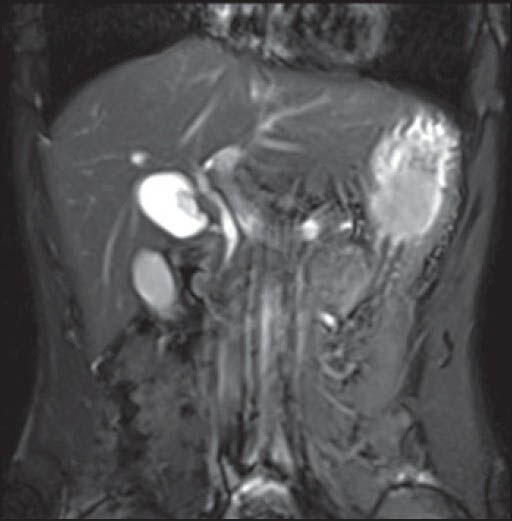 Magnetic resonance cholangio pancreatography showing double gallbladder with normal calibre common bile duct