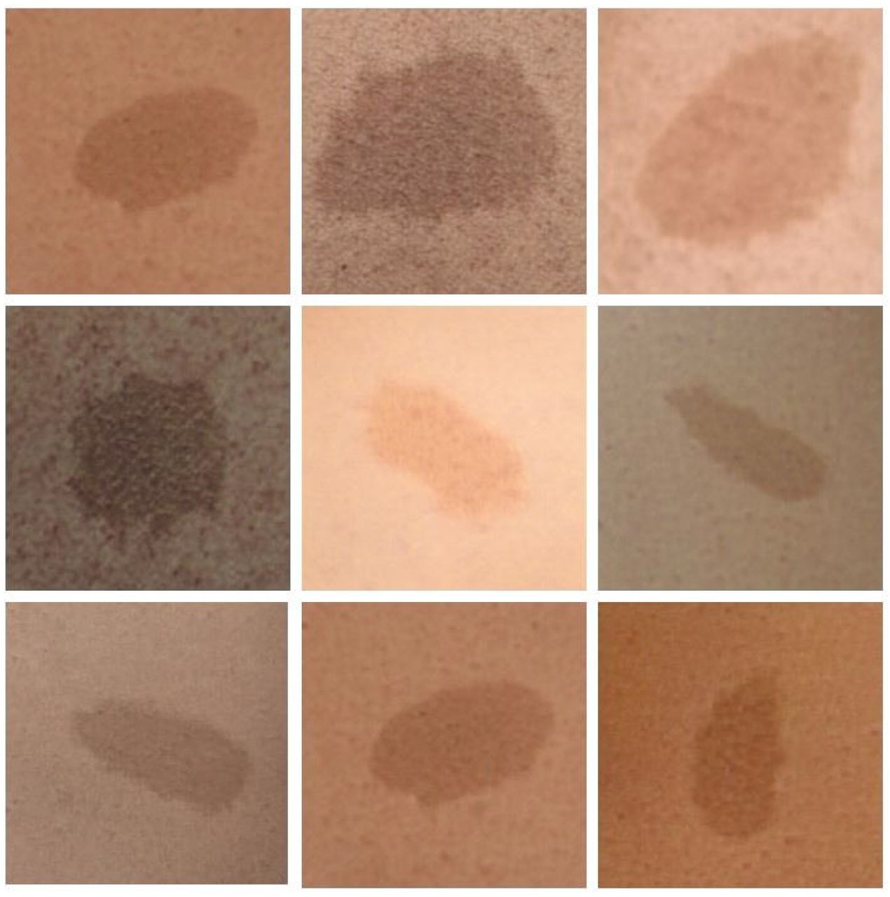 Examples of generated images of café-au-lait macules (CALMs) in Neurofibromatosis type 1 (NF1). Images, which were generated via a generative adversarial network (GAN),13 and which were felt to appear subjectively (by trained genetics clinicians) accurate, can be used for additional purposes, such as style-mixing or morphing.