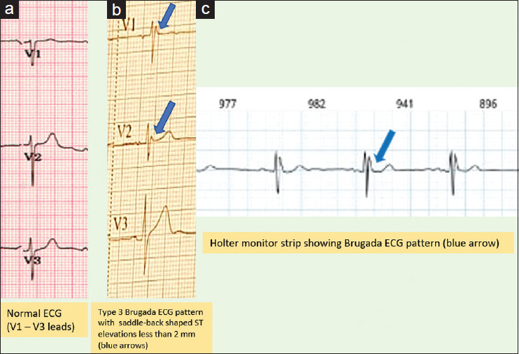 (a) shows V1,V2,V3 leads in a normal ECG for reference, (b) shows V1,V2,V3 leads with saddle-back pattern in the patient’s ECG (blue arrows), (c) shows Holter monitor strip of the patient confirming Brugada’s type 3 pattern (blue arrows)