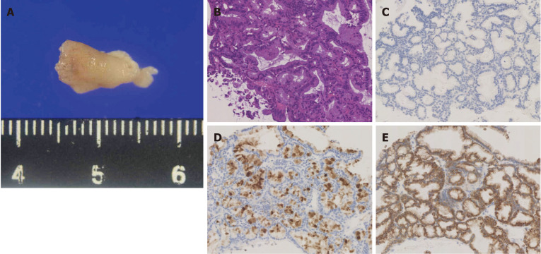 Pathological findings. A: Pathological specimen obtained using peroral cholangioscopy (approximately 12 mm diameter); B: Hematoxylin and eosin stains showing intermediate nuclear atypia; C-E: Immunohistochemical analysis of MUC2 (undetectable) (C), MUC5AC (positive) (D), and MUC6 (positive) (E).
