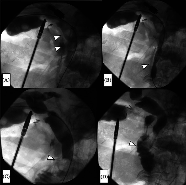 Radiographic images during one‐stage laparoscopic transcystic papillary balloon dilation and laparoscopic cholecystectomy. A, The presence of choledocholithiasis was confirmed by injecting contrast medium into the bile duct from the sheath (arrowheads). B, Balloon dilation of the papilla of Vater (arrowhead). C, The stones were extruded using the balloon (arrowhead), and the common bile duct was cleaned. D, The absence of any residual stones was confirmed, and a pigtail‐shaped drainage catheter (arrowhead) was inserted to help prevent edema of the papilla of Vater and pancreatitis