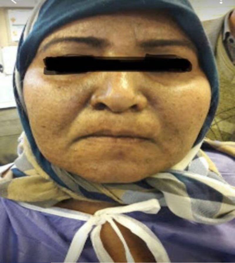 The patient’s face shows facial hyperpigmentation