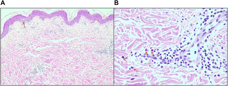 (A) Edema of the papillary dermis and focal area of vacuolar degeneration of the basal layer of the epidermis (arrow), 10x magnification. (B) Details for the presence of eosinophils (arrows), 20x magnification.