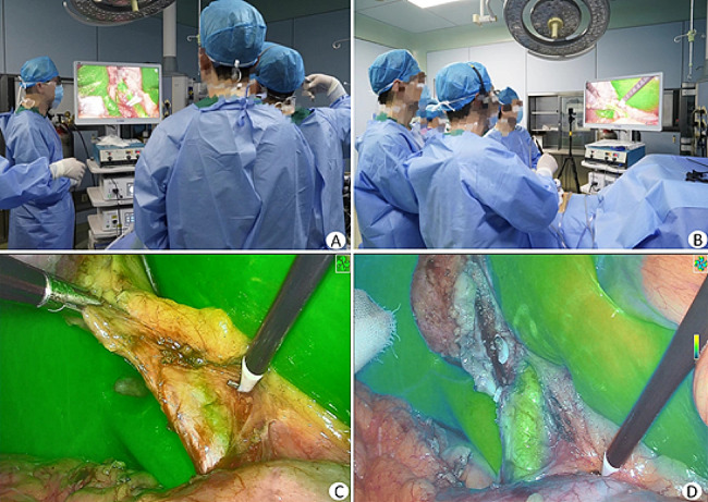 Intraoperative photographs of LCBDE under fluorescence navigation. A-B Intraoperative photograph; C Inflammation and edema of the gallbladder triangle made identification of the CBD difficult, but visualization of the CBD was achieved under fluorescence mode; D The CBD was separated under fluorescence navigation