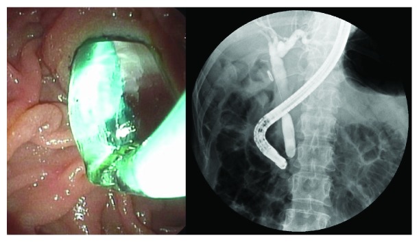 Endoscopic papillary large balloon dilation alone was performed.