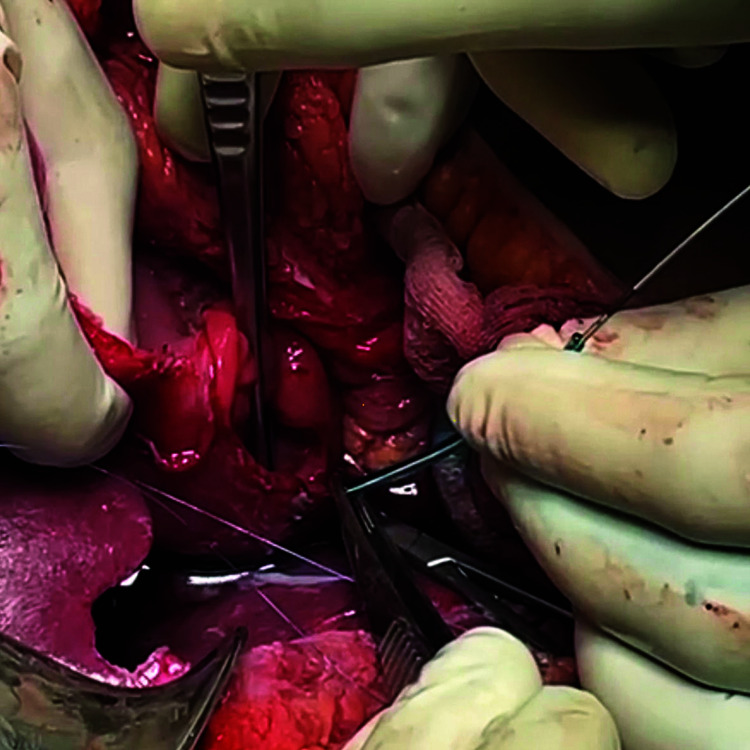 Image depicting the technique of securing a guidewire into the ampulla of duodenum through the previously secured IFT/cannula (arrow = guidewire in the cannula)