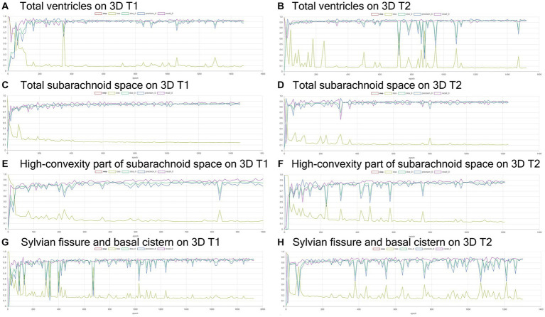 Results of training for deep learning of the semantic segmentation. The Dice scores (emerald green line), loss (lime green line), precision (blue), and recall (purple) for the automatically segmented volumes of the total ventricles (A,B), total subarachnoid spaces (C,D), high-convexity part of the subarachnoid space (E,F), and Sylvian fissure and basal cistern (G,H) on 3D T1-weighted (A,C,E,G) and T2-weighted MRIs (B,D,F,H).