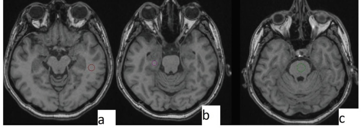 Measurement levels. Temporal lobe (a), hippocampus (b), and brainstem (c).