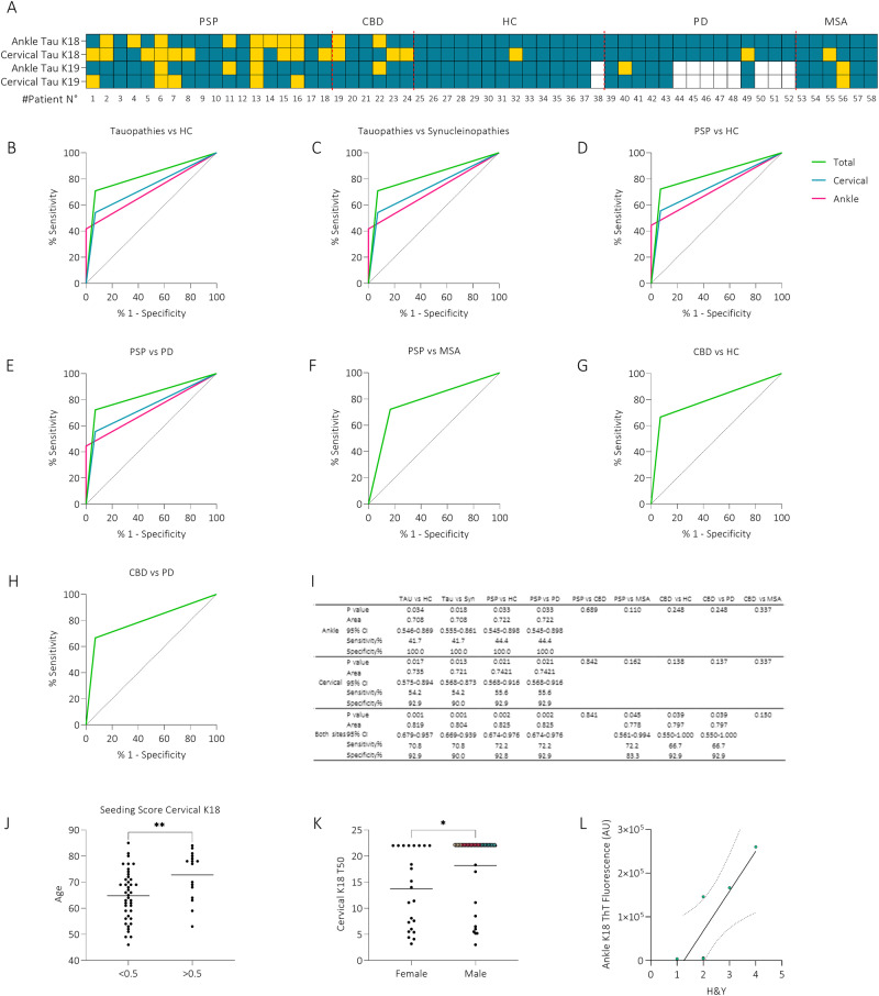 Diagnostic performance and correlation analysis.A Heatmap showing positive (yellow) and negative (blue) patients analyzed with TauK18 and TauK19 in ankle and cervical sites. B–H ROC curves analysis of TauK18 positivity/negativity in ankle (fuchsia), cervical (blue), and both sites (green). The referral line is reported in black. I The table provides the asymptotic significance, AUC with 95% CI, sensitivity, and specificity for each comparison. P-values < 0.05 were considered significant. J Box plot showing differences in age between subjects with seeding scores lower or higher than 0.5. Each dot represents a patient and bars the mean of the group. K Box plot showing differences in cervical TauK18 T50 between male and female subjects. Each dot represents a patient and bars the mean of the group. L Correlation between ankle TauK18 ThT fluorescence signal and H&Y in CBD (R = 0.865, P = 0.026, n = 6). The regression line is reported together with its 95% CI (dashed line).
