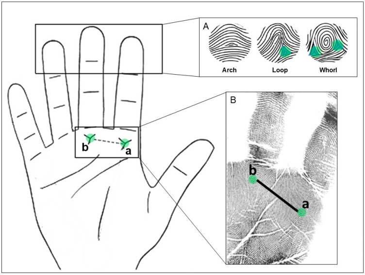 (A) Different fingertip patterns (left to right): arch, loop and whorl with the triradius marked with green circles. (B) Handprints where the triradii a and b are indicated. The total a-b ridge count (TABRC) corresponds to the sum of the number of ridges between both triradii from the right and left hands. Figures adapted from [12,23].