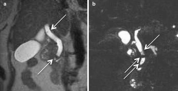 Magnetic resonance cholangiopancreaticography (MRCP) image demonstrates common bile duct (CBD) calculi (arrows). a T2-weighted short echo time sequence (TR/TE 2000/79 ms, slice thickness 5 mm, scan time 3 min 44 s). The smallest stone was 3.19 mm in a dilated CBD. b T2-weighted turbo spin-echo sequence (TR/TE 1800/635 ms, slice thickness 1.15 mm, scan time 3 min 44 s). The smallest stone in a nondilated duct was 4.55 mm in diameter